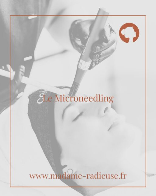 Le microneedling est une technique qui permet de stimuler les mécanismes naturels de régénération de la peau.
En créant des micro perforations contrôlées, ce soin contribue à améliorer la texture de la peau, atténuer les cicatrices, lisser les ridules ou encore améliorer l’éclat du teint .
Comme pour chaque soin proposé au cabinet Madame Radieuse, une évaluation de la peau est réalisée pour adapter un protocole personnalisé.
#microneedling #qualitédepeau #soinsduvisage #dermoesthétique #bordeauxnansouty